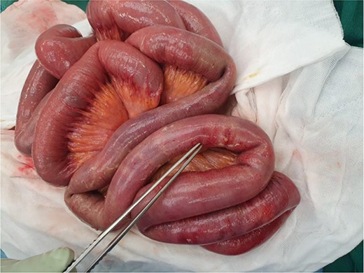 Intraoperative photograph of the visually normal but thickened small bowel on palpation at laparotomy (second surgery). Forceps pointing to an area of pus with pinpoint perforation.