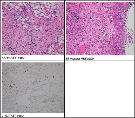 (A) Mesentery and (B) bowel pathology (H&E, original magnification, 100×). (C) Resected metastatic small bowel pathology (GAT3 ×100) typical for either urothelioma or breast carcinoma. *H&E, hematoxylin and eosin. **GATA3 is a transcription factor important in the differentiation of breast epithelia, urothelial and subsets of T-lymphocytes.
