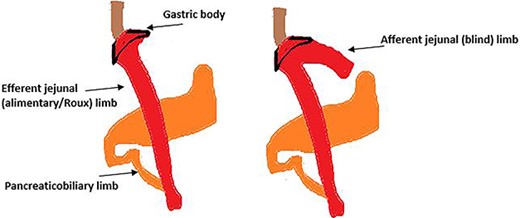 A schematic drawing of normal RYGB anatomy (on the left) and RYGB complicated by CCS (on the right).