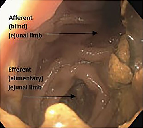 Upper endoscopy image with view from gastric pouch demonstrating both the blind afferent jejunal limb and the alimentary limb.