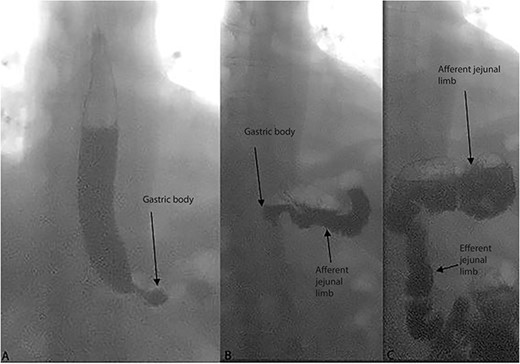 Sequential images of dynamic upper gastrointestinal tract fluoroscopy examination with barium meal in the patient. Opacification is first seen in the esophagus and gastric body (A), followed by the afferent jejunal (blind) limb (B) and last the efferent jejunal (alimentary/Roux) limb (C).