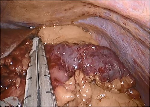 Intraoperative photograph showing the blind, afferent jejunal limb.