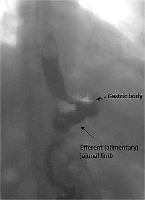 Postoperative images of upper gastrointestinal tract fluoroscopy examination with barium meal, demonstrating anatomy post-resection of the afferent jejunal (blind) limb.