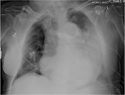 Erect AP chest X-ray indicating opacification of the left mid and lower zones, with thoracic vascular graft in situ.