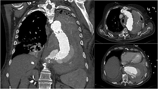 Coronal and axial CT thoracic aortogram indicating large Type 1 endoleak with large left haemothorax.