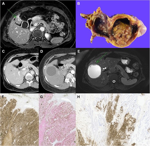 Clinicopathological images of the patient. (A) Preoperative MRI showing GB cancer, (B) gross specimen of GB with papillary tumor, (C, D) follow-up imaging showing the increased size of cystic lesion in the liver, (E) MRI showing cystic mass in segment V with enhancing mural nodule and wall thickening, (F) immunohistochemical staining with chromogranin A, (G) synaptophysin (red) and Ki-67 (brown) double staining in neuroendocrine carcinoma of the liver, (H) chromogranin A staining in the GB tumor, which reveals neuroendocrine component (original magnification: ×100).