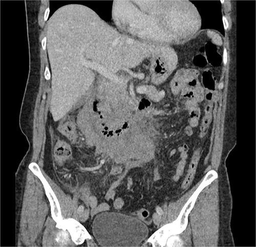 CT abdomen, coronal view. Hyperdense fluid centered around the duodenum and tracking into the paracolic gutters. Appearance concerning for paraduodenal hemorrhage, infiltrating mass was considered less likely.