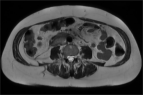 MRI abdomen, axial view. Resolving paraduodenal hematoma.