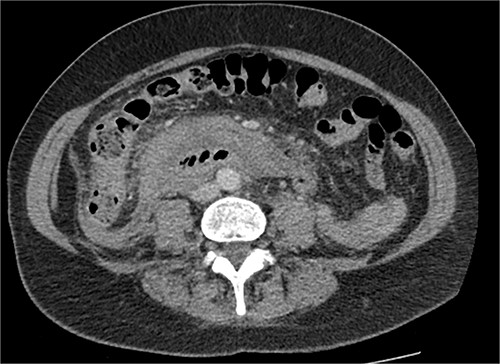CT abdomen, axial view. Hyperdense fluid centered around the duodenum and tracking into the paracolic gutters. Appearance concerning for paraduodenal hemorrhage, infiltrating mass was considered less likely.