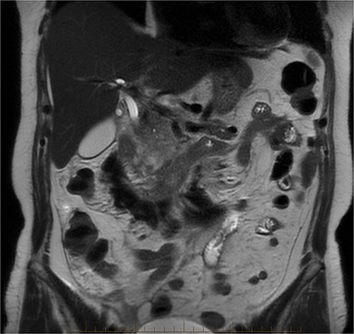 MRI abdomen, coronal view. T2 hypointense, T1 iso to hyperintense material surrounding D2/D3 without enhancement in keeping with hemorrhage. No vascular or bowel wall lesion identified.