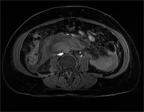 MRI abdomen, axial view. T2 hypointense, T1 iso to hyperintense material surrounding D2/D3 without enhancement in keeping with hemorrhage. No vascular or bowel wall lesion identified.