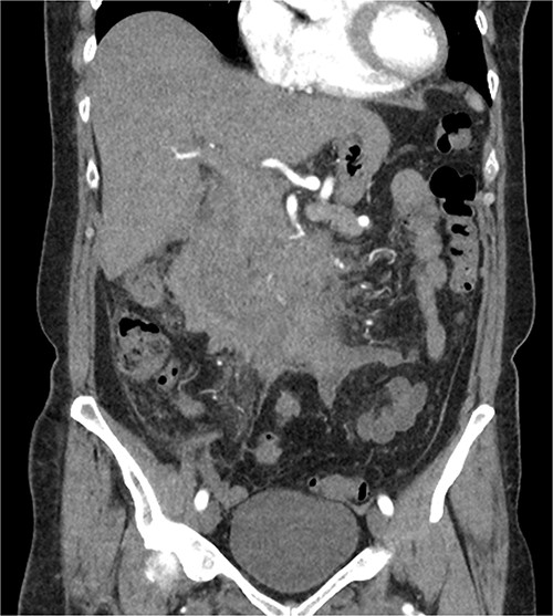 CT triple phase, coronal view. Stable periduodenal hematoma, no acute hemorrhage or vascular abnormality identified.