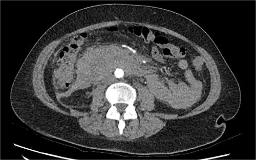 CT triple phase, axial view. Stable periduodenal hematoma, no acute hemorrhage or vascular abnormality identified.