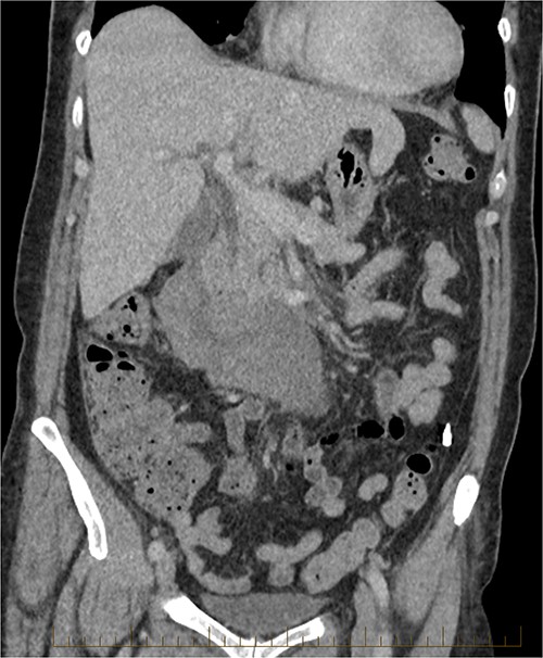 CT abdomen, coronal view. Slight interval decrease in size of previously identified periduodenal hematoma.