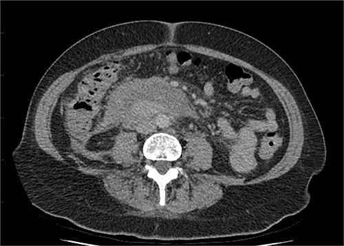 CT abdomen, axial view. Slight interval decrease in size of previously identified periduodenal hematoma.