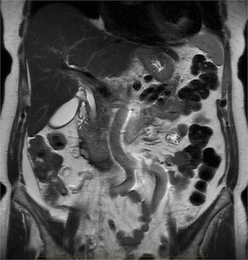 MRI abdomen, coronal view. Resolving paraduodenal hematoma.