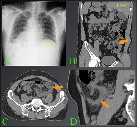 The images of appendicitis in a patient with situs inversus. (A) Chest X-ray of the chest shows that the heart is on the right side. (B–D) The CT images show the left-sided acute appendicitis with surrounding fatty infiltration (arrows). The root of the appendix located high in the left lumbar position is also seen (circle). Note where the liver is located on the left side.