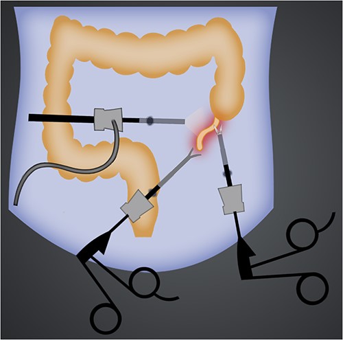Illustration of port sites of laparoscopic left-sided appendectomy.
