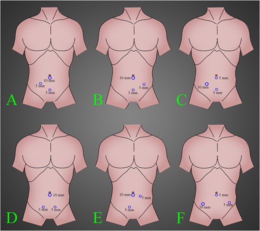 The most common position of the ports in laparoscopic left-side appendectomy according to our knowledge and experience. (A) A 10-mm trocar inserted in the umbilical region, a 5-mm trocar inserted in the suprapubic region and a 5-mm trocar inserted in the right lower quadrant region. (B) A 10-mm trocar inserted in the umbilical region, a 5-mm trocar inserted in the suprapubic region and a 5-mm trocar inserted in the left lower quadrant region. (C) A 10-mm trocar inserted in the right lower quadrant region, a 5-mm trocar inserted in the umbilical region and a 5-mm trocar inserted in the suprapubic region. (D) A 10-mm trocar inserted in the umbilical region and two 5-mm trocars inserted in bilateral suprapubic region. (E) A 10-mm trocar inserted in the umbilical region, a 5-mm trocar inserted in the right suprapubic region and a 5-mm trocar inserted in the left lower quadrant region, a little to upward. (F) A 10-mm trocar inserted in the right lower quadrant region, a 5-mm trocar inserted in the umbilical region and a 5-mm trocar inserted in the left lower quadrant region.