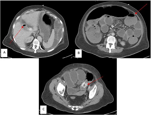 CT imaging in the emergency department (ED) with components of Rigler’s Triad (marked by red arrows): (A) Pneumobilia, (B) distended loops of bowel consist with large bowel obstruction, (C) gallstone impacted in the sigmoid colon.