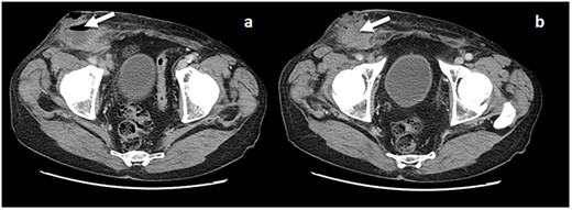 (a and b) CT scan with evidence of a fluid collection in the right inguinal area (arrow) and an apparent recurrent hernia.