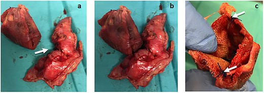 (a) The plug removed from the peritoneal cavity (left) and the cecum atypical resection specimen (right), where the 2 cm perforation area can be seen (arrows). (b) Plug and cecum positioned according to its intra-operatory location, in which the erosion of the cecum wall was observed in direct contact with the plug. (c) Plug still with two fixation points (arrows).