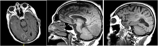 MRI of brain, with and without contrast, identified four enhancing lesions, concerning for intracranial metastatic disease, located in the right temporal (left), occipital (center) and frontal lobes (right).