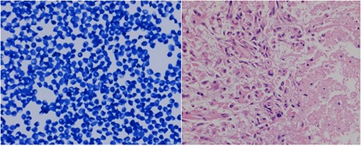 The tiny frozen section preparation confirmed the presence of malignancy, histologically reminiscent of lymphoma versus glioma. The permanent sections showed atypical glial proliferation with marked nuclear pleomorphism and necrosis (right corner of image).
