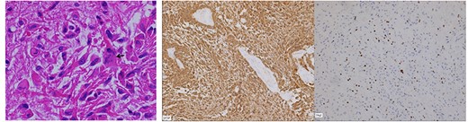 The permanent sections showed atypical glial proliferation with marked nuclear pleomorphism, increased vascularity and atypical mitoses (arrow in the left image). Immunostains were diffusely positive for GFAP (center image), and variably positive for Olig2.