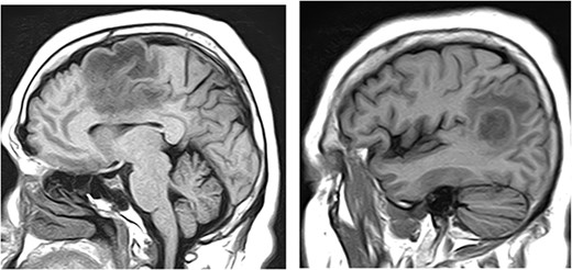 MRI of brain without contrast showed two enhancing masses in the left frontal and left parieto-occipital lobes, 2.1 cm × 2.7 cm × 1.9 cm and 1.9 cm × 2.0 cm × 2.5 cm, respectively.