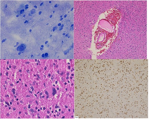 (A) Frozen section biopsy is consistent with a glial neoplasm. Permanent sections: (B) glial neoplasm with vascular endothelial proliferation; (C) nuclear pleomorphism; (D) Olig-2 immunostain positivity.