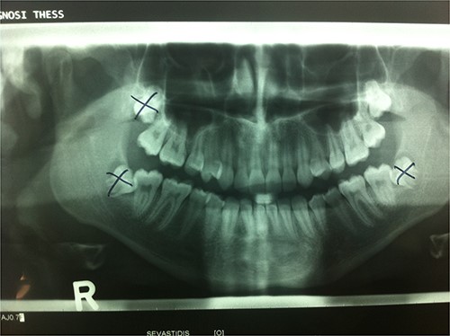 Orthopantomograph showing the location of third molars before their removal. The left maxillary third molar was displaced into the ipsilateral infratemoral fossa.