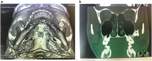 CT 3D reconstruction showing the exact location of the displaced molar into the infratemporal fossa behind the zygoma.