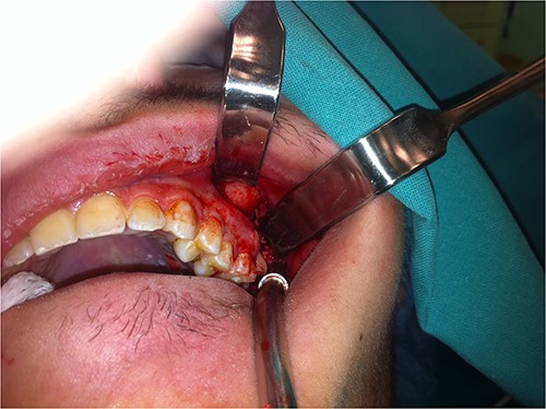 Photograph showing the intraoral approach to the infratemporal fossa through a long incision into the bycco-gingival sulcus.