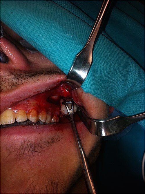 Photograph showing removal of the tooth with the aid of long Langebeck retractors.