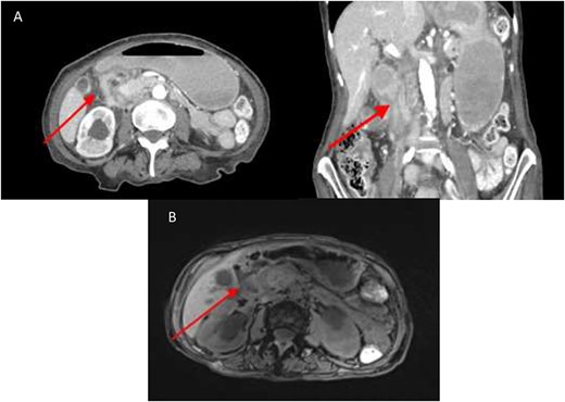 (A) CT abdomen showing marked luminal narrowing (red arrow) at the second part of the duodenum (axial and coronal section). (B). T1 MRI Showing retroperitoneal soft tissue (red arrow) paralleling the second part of duodenum resulting in extrinsic compression.