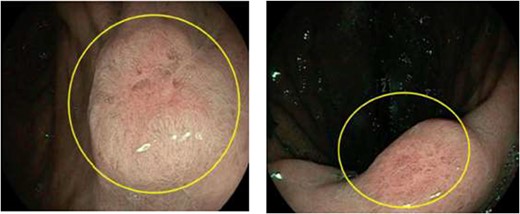 Nodules with unusual surface vascular pattern in found in gastric antrum (left) and incisura (right) at the time of endoscopy—metastatic tissue of breast origin confirmed by biopsy.