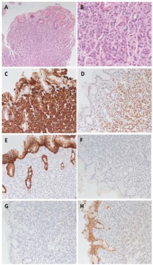 Metastasis histology and immunohistochemistry. (A) Photomicrograph of lobular carcinoma metastasis with infiltration into gastric mucosa (HE 100×). B: High power photomicrograph of metastatic tumour cells (HE 400×). (C)–(D): Tumour cells are positive for CK7 (C) and GATA3 (D), consistent with breast primary origin (200×). (E) Loss of e-Cadherin staining within tumour cells in contrast to gastric epithelium supporting invasive lobular carcinoma (200×). (F)–(H) Metastatic tumour cells are negative for oestrogen receptor staining (F), progesterone receptor staining (G) and equivocal (2+) for HER2 staining (H) (200×).