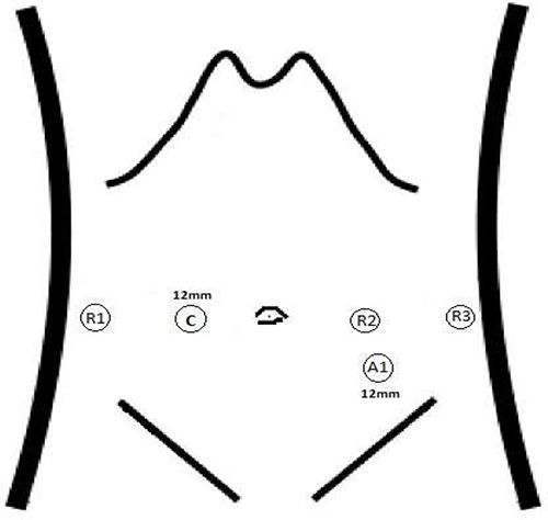 Placement of trocars. The ports for the camera (C), robotic arms (R1–R3) and the assistant port (A) are shown.