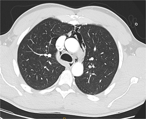 CT chest axial, anterior pneumomediastinum.