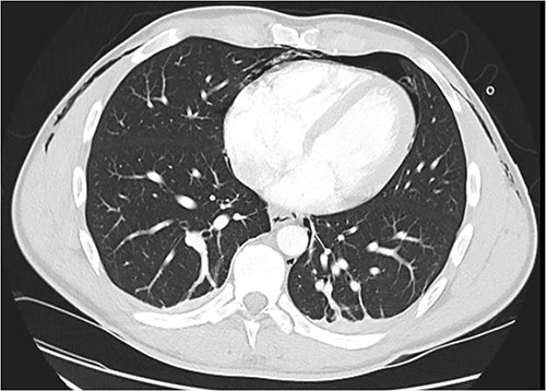 CT chest axial, small left pneumothorax and chest wall subcutaneous emphysema.