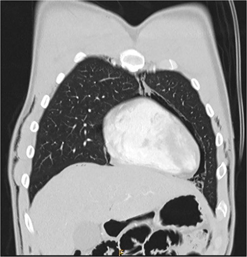 CT chest coronal, pneumomediastinum and bilateral subcutaneous emphysema.
