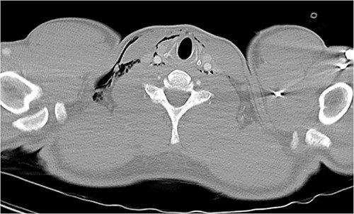 CT chest and neck axial, subcutaneous emphysema extending to neck.