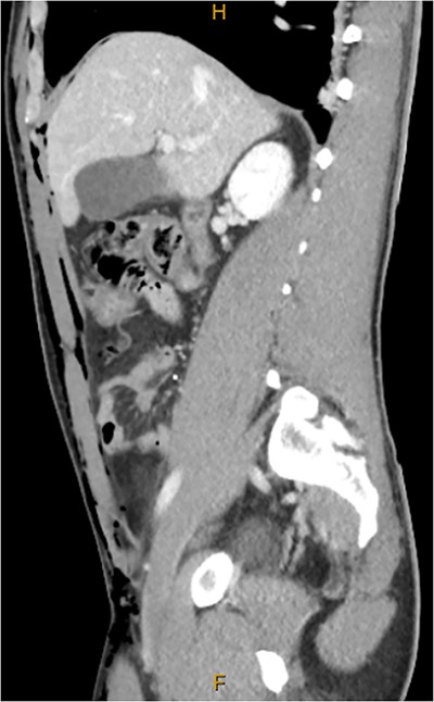 CT abdomen and pelvis sagittal, abdominal wall subcutaneous emphysema with gas between muscle layers.