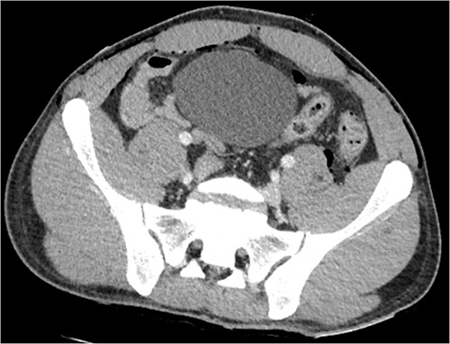 CT abdomen and pelvis axial, left retroperitoneal gas locules overlying iliopsoas muscle.