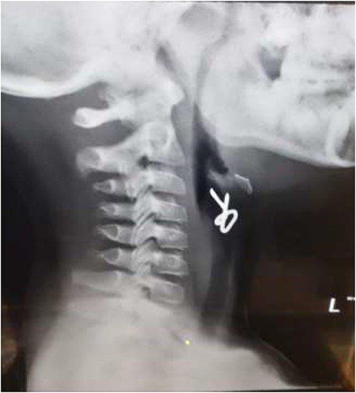 Lateral neck X-ray showing a radio-opaque object with sharp edges visible.
