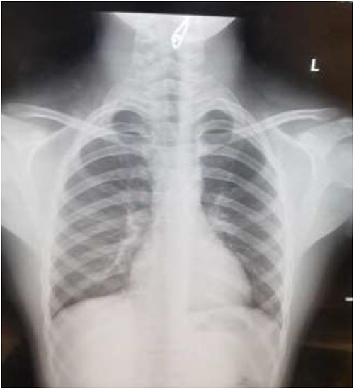 AP chest radiograph showing the sharp-edged radio-opaque object.