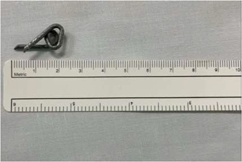 Successful removal of the barbed wire measuring ⁓2.0 cm.