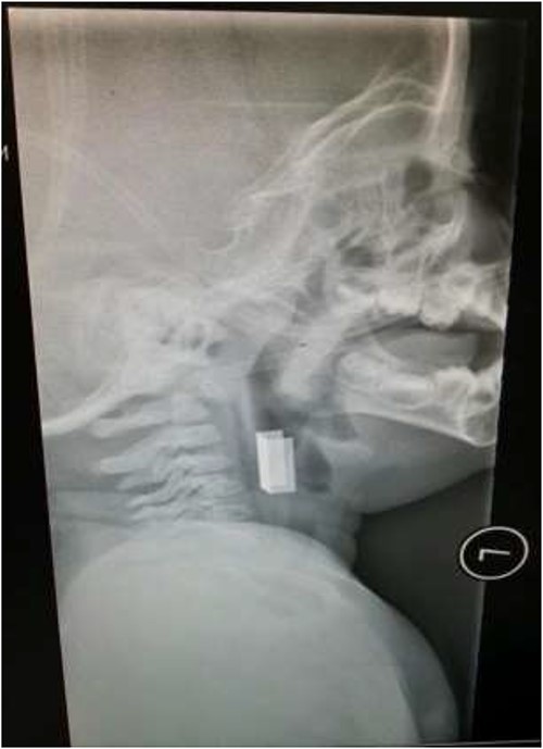 Lateral neck X-ray showing a radio-opaque object in the upper airway.