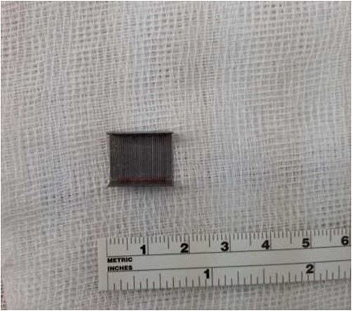 Successful removal of staple block from the upper airway.